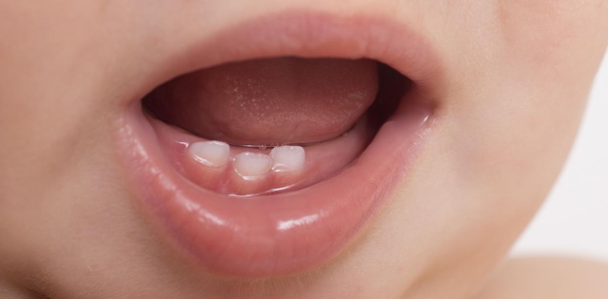 Freiburg: Chalk teeth in children below average