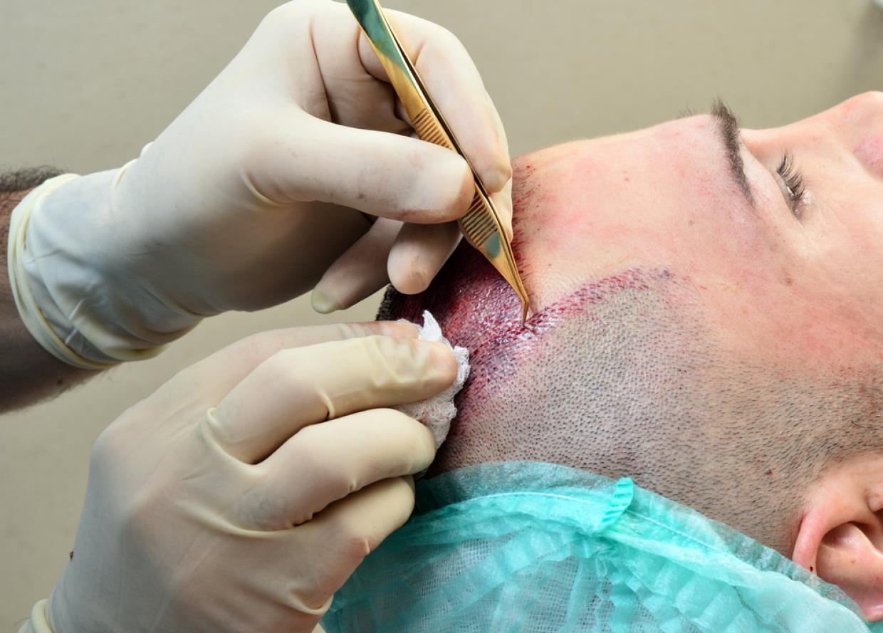 Kopfwunden stellen sich als Haartransplantation heraus | Radio Regenbogen